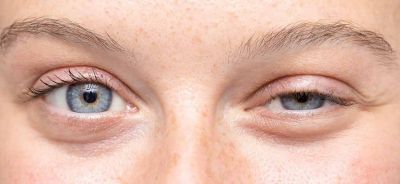 Kas güçsüzlüğünün nedeni Miyastenia Gravis olabilir