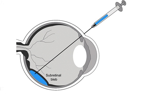 Yeni Gen Terapisi Stratejileri Görüş Kaybıyla Savaşın Yeni Yöntemi