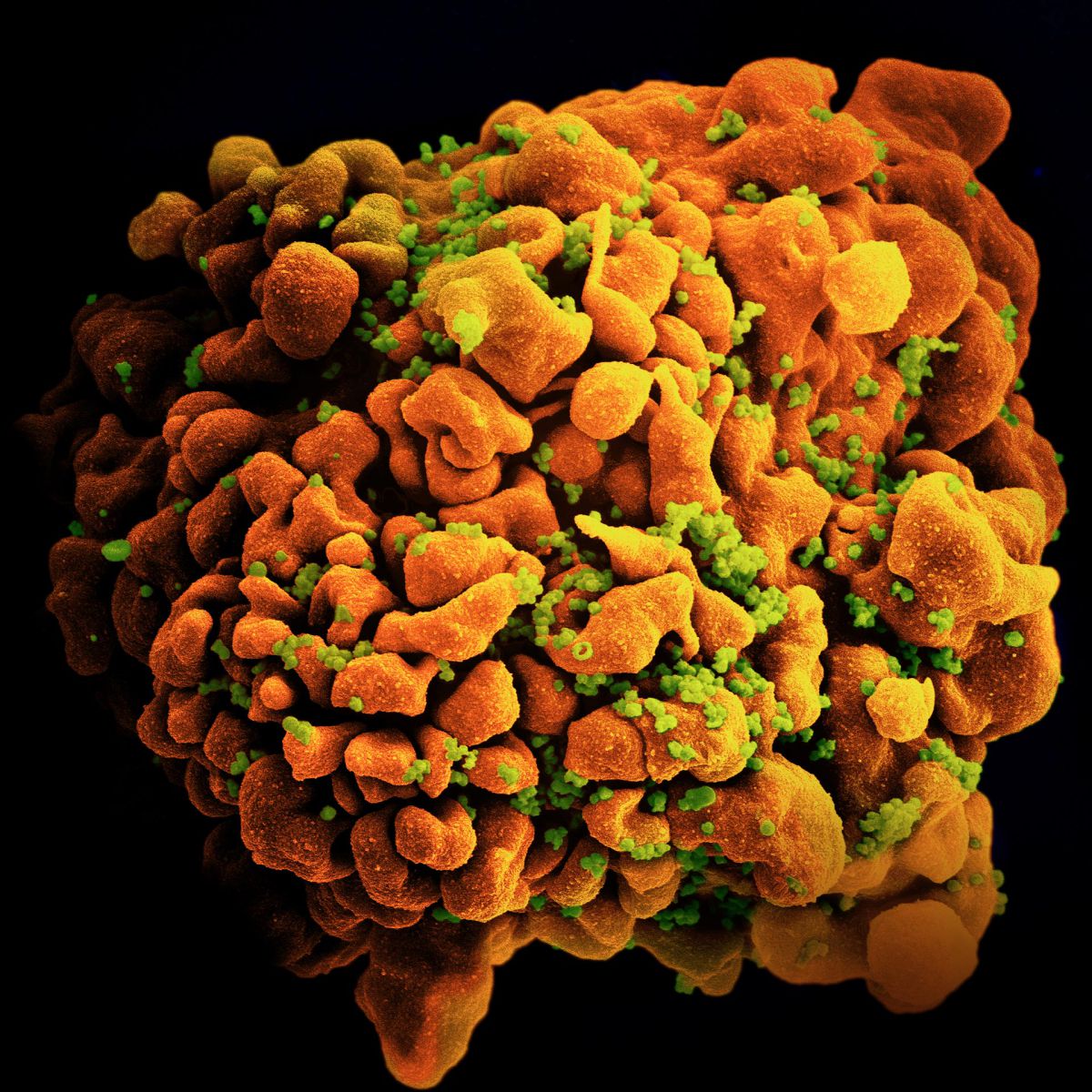 Yeni HIV Varyantı Keşfedildi